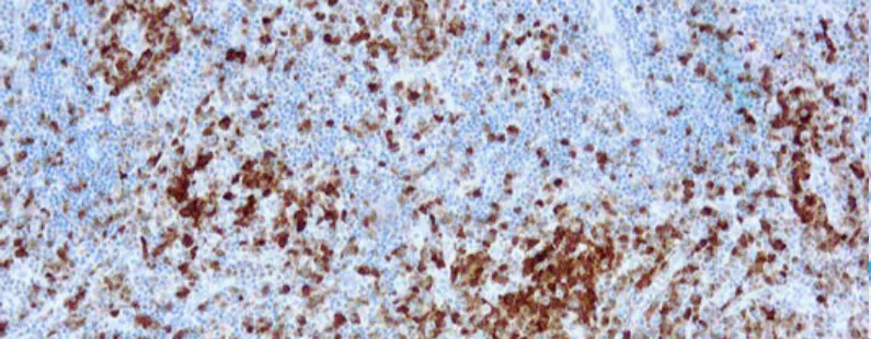 Anaplastic Lymphoma Kinase p80