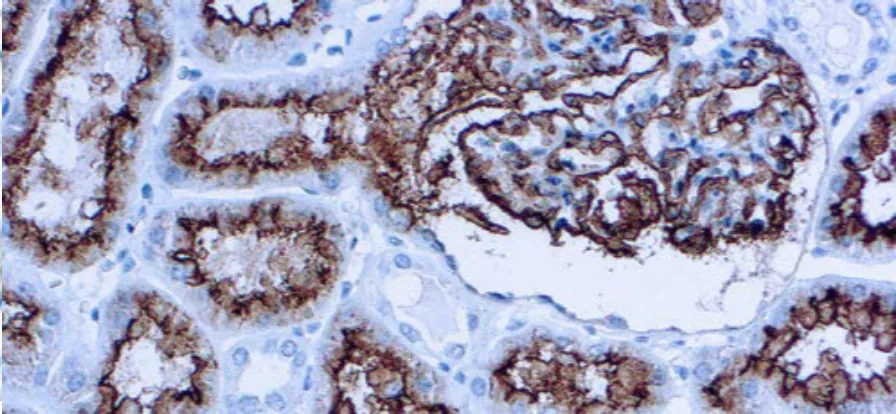 CD10 (CALLA)