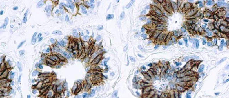 Epithelial Antigen (Ber-EP4)