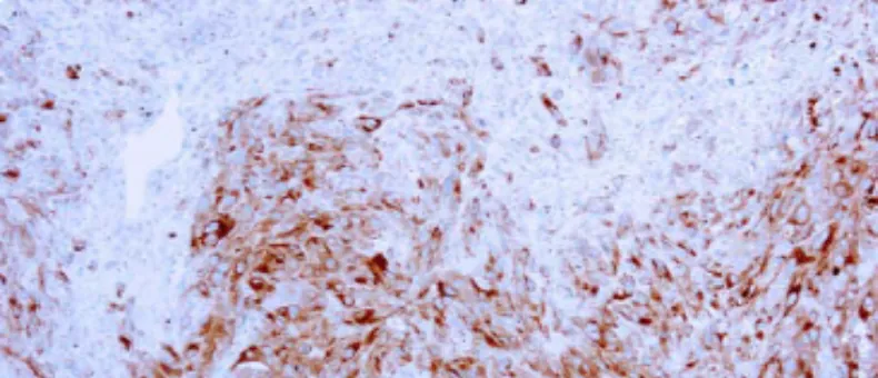 MART-1/Melan-A, Melanoma Marker