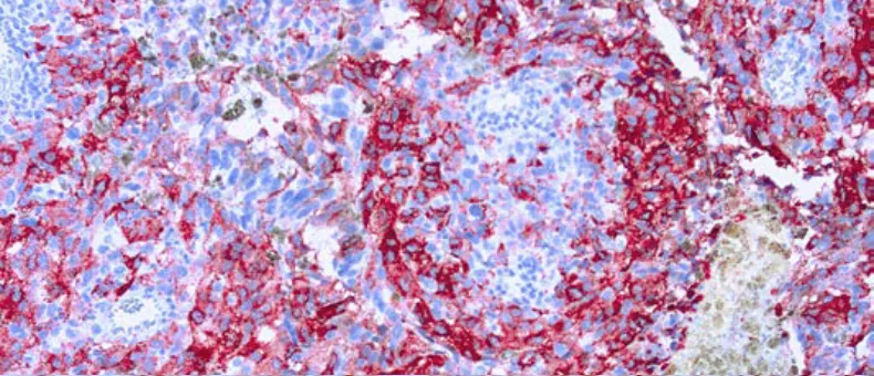 Melanoma (HMB45)