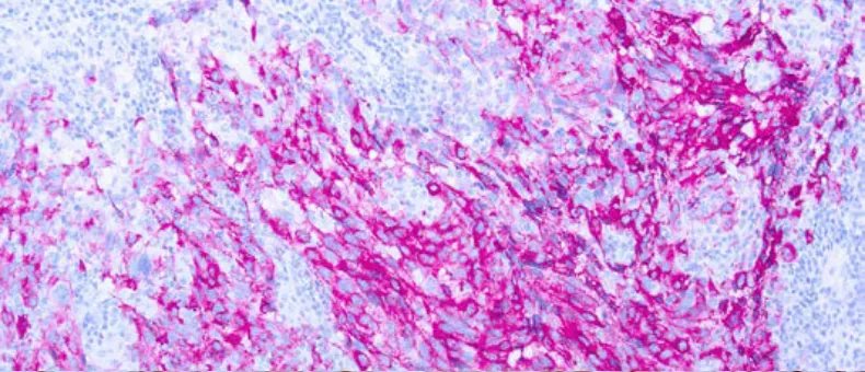 Melanoma (PNL2)