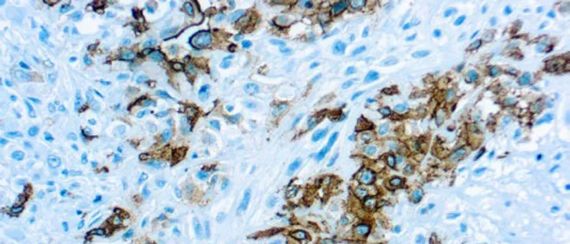 Mesothelioma