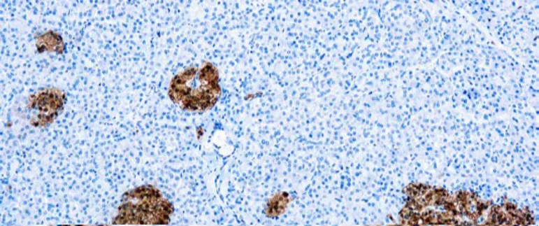 Neuron Specific Enolase, NSE
