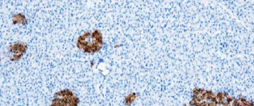 Neuron Specific Enolase