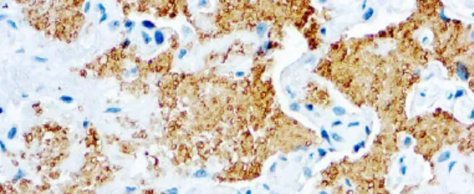 Pneumocystis Carinii