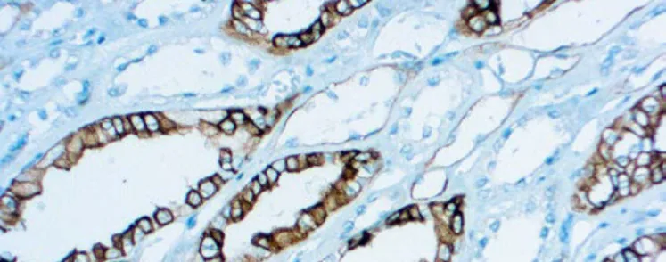Renal Cell Carcinoma (gp200)