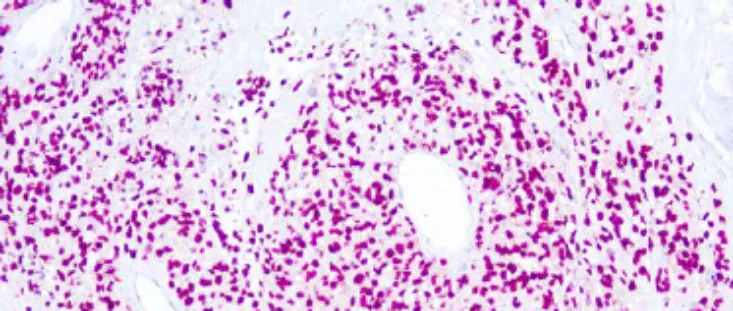 SOX10 (Melanoma Marker)