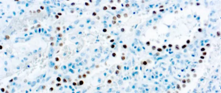 Thyroid Transcription Factor-1, TTF-1