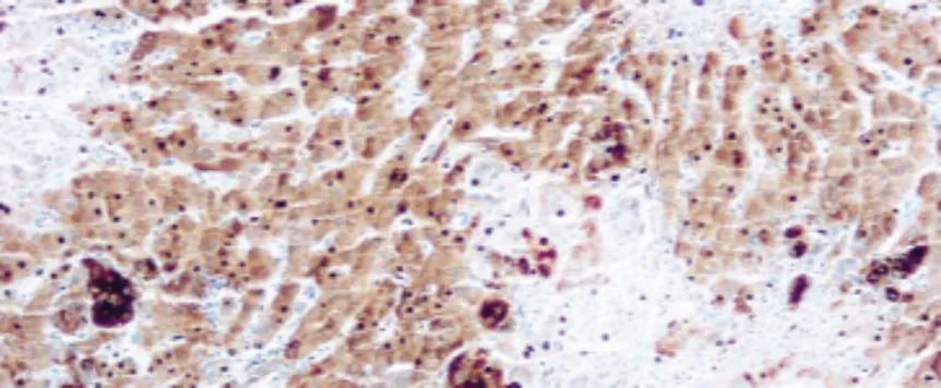 α Fetoprotein (AFP)